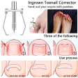 Pack of 2 - Ingrown Toe Nail Correction Tool - Gold Discount