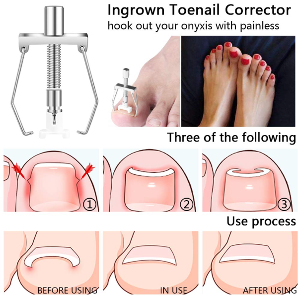 Pack of 2 - Ingrown Toe Nail Correction Tool - Gold Discount