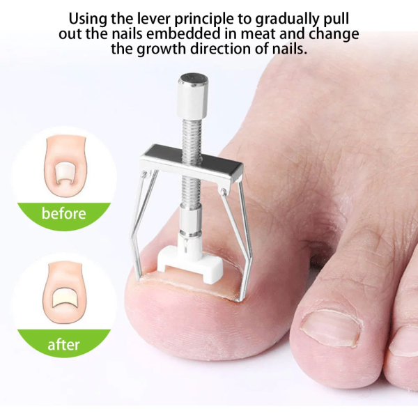 Pack of 2 - Ingrown Toe Nail Correction Tool - Gold Discount